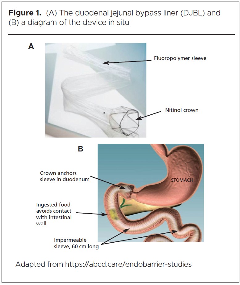 Figure 1.  (A) The duodenal jejunal bypass liner (DJBL) and (B) a diagram of the device in situ